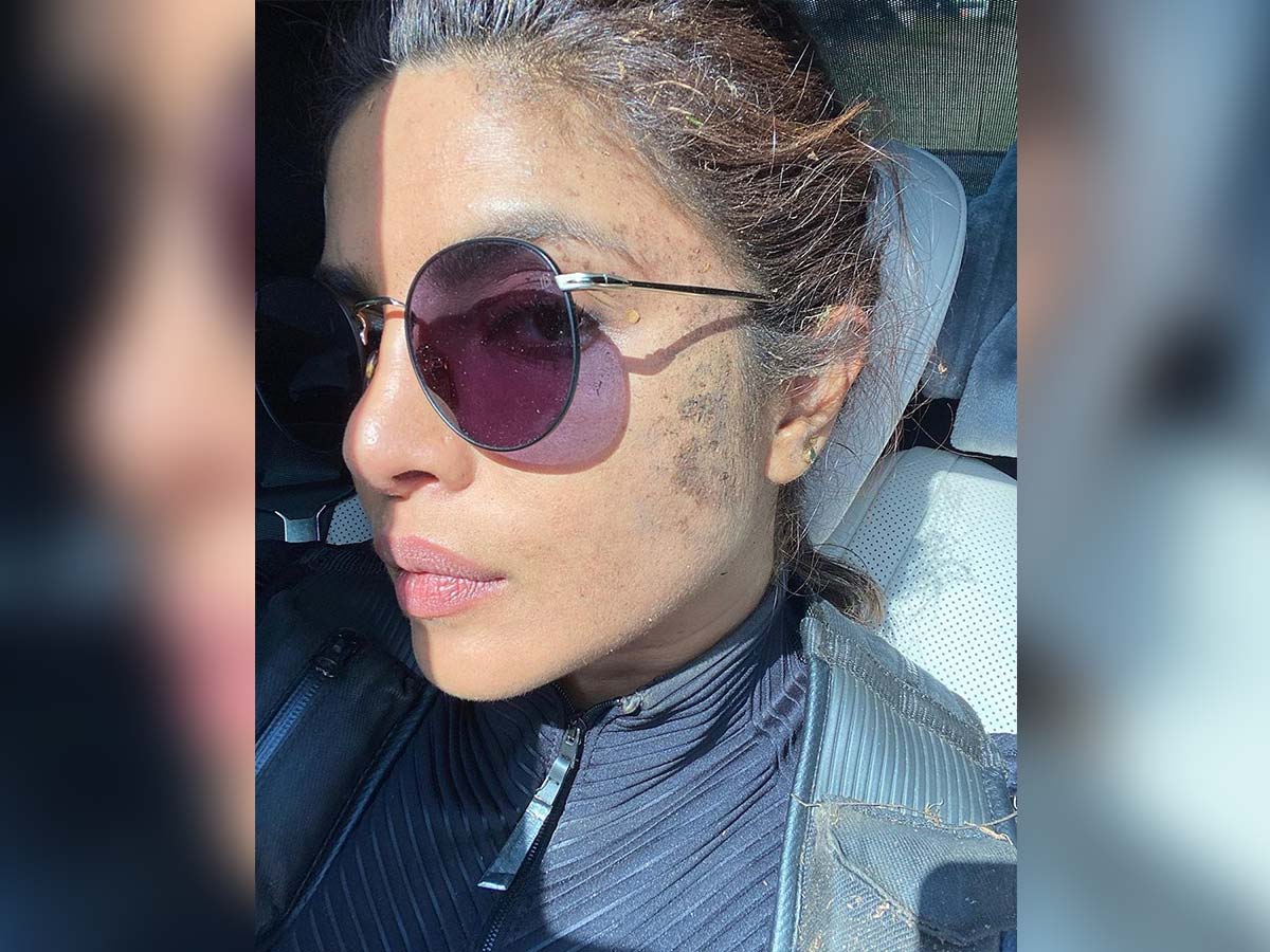 Priyanka Chopra injured her forehead